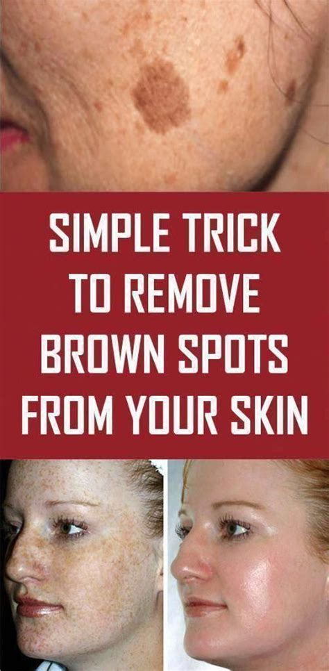 The Truth Behind Brown Spots On Face Spots On Face Brown Spots On