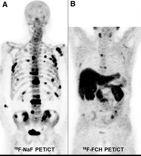 Evaluation Of Prostate Cancer Bone Metastases With F NaF And F Fluorocholine PET CT