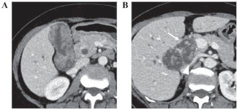 Findings Of Contrast Enhanced Ct A Contrast Enhanced Ct Revealed