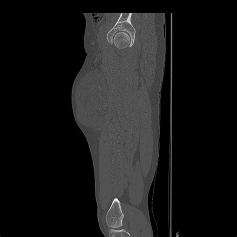 Myxoid Liposarcoma Thigh Anterior Compartment Image