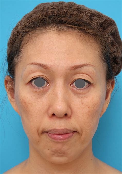 40代後半女性の引っ込んでいる顎にシリコンプロテーゼを入れた症例写真 症例写真 ： 美容整形の高須クリニック（東京赤坂・横浜・名古屋・大阪）