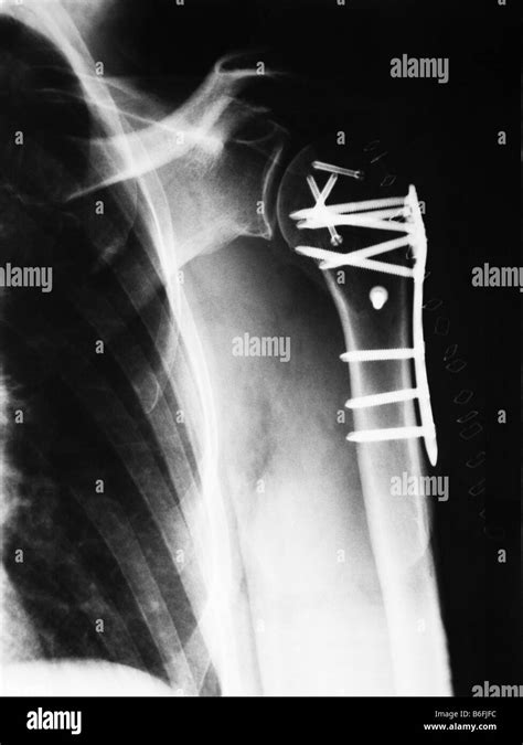 X Ray Of A Broken Upper Arm After Surgery Showing Plates And Screws