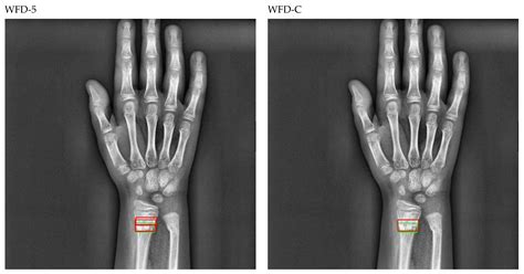 Sensors Free Full Text Fracture Detection In Wrist X Ray Images