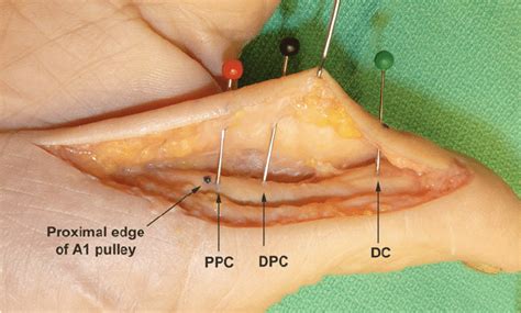 Normally wrist extension causes passive flexion of the digits at the mcp, pip, and dip joints. Exposure of the flexor tendon sheath demonstrating the location of the... | Download Scientific ...