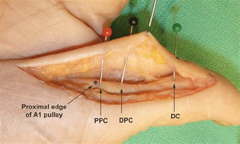 Foot and ankle pain is often due to tendon injuries. Exposure of the flexor tendon sheath demonstrating the location of the... | Download Scientific ...