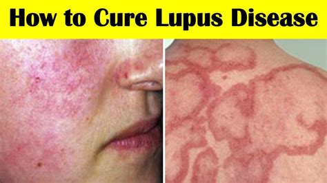 How To Cure Lupus Disease 9 Home Remedies For Lupus Pain Youtube