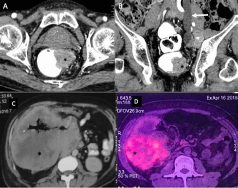 A B Rectal Carcinoid With Liver Metastasis In A 68 Year Old Male