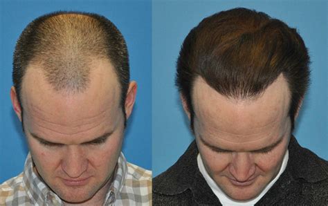 Norwood Class IIIv 3000 FUE Grafts Case Study Carolina Hair Surgery