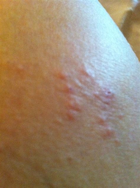 Itchy Bumps On Arms Pictures Photos