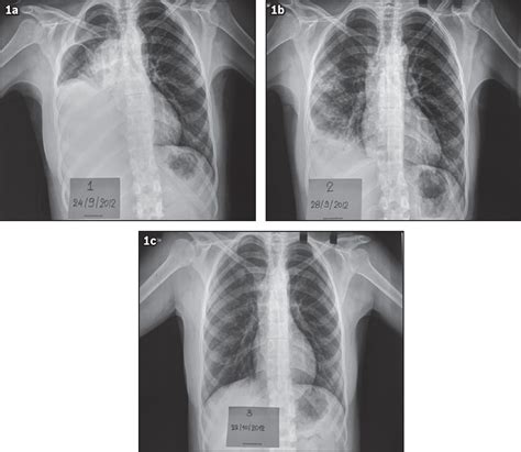 Conservative Treatment Of Hydrothorax In A Patient Receiving Peritoneal