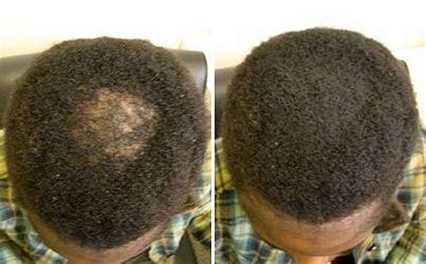 A Quick Fix For Your Bald Spots And Damaged Hairline Super Million Hair