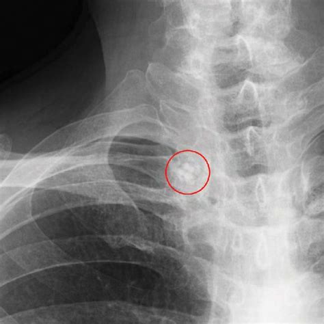 The Ganglion Cyst On Right Clavicle Near The Sternoclavicular Joint