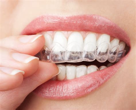 How to brush your teeth with braces. CLEAR BRACES | Parchmore Dental Centre