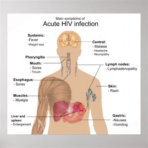 Main Symptoms Of Acute Hiv Infection Poster