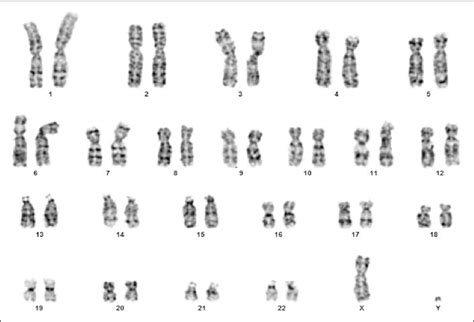 Figure 1 From Adolescent Female With Turner S Syndrome And 46 X Der Y