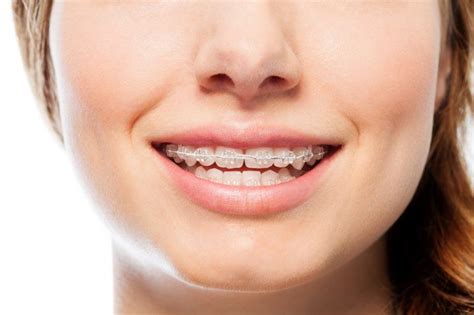 top 5 faqs about clear ceramic braces shirck orthodontics ohio orthodontists
