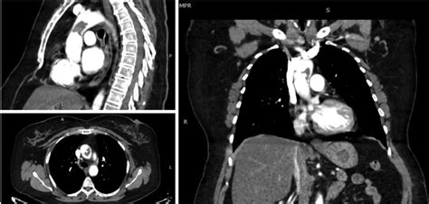 Contrast Enhanced Computed Tomography With Multiplanar Reconstruction