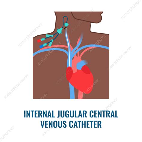 Central Venous Catheter Illustration Stock Image F0357695