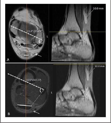 Figure 1 From Mri Evaluation Of Achilles Tendon Rotation And Sural