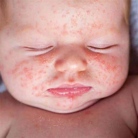 Your Babys Skin And Rashes Healthy Living Pedia
