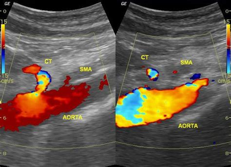 Acute Superior Mesenteric Artery Occlusion On Ultrasound Radiology