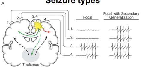 Epilepsy And Anti Seizure Flashcards Quizlet