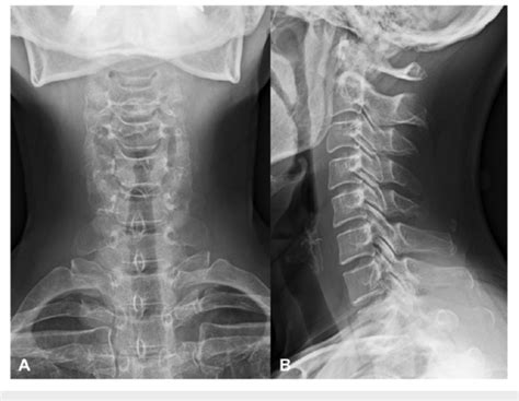 Plain Radiographs Of The Cervical Spine On Initial Presentation