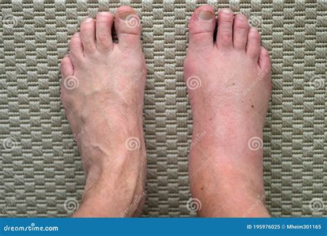 Man With Badly Swollen Foot From Allergic Reaction Stock Image Image