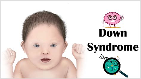Down Syndrome Signs Symptoms Clinical Features And Long Term
