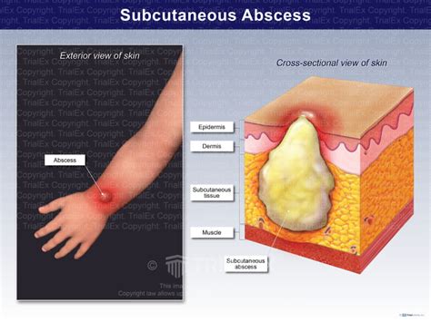subcutaneous abscess trialexhibits inc