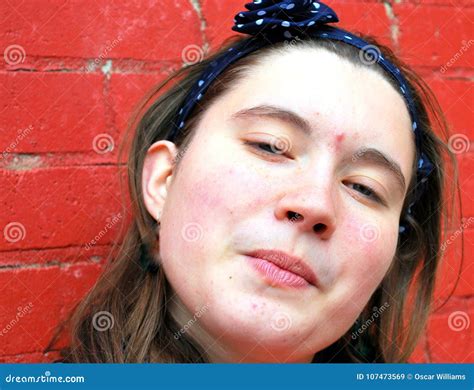 Female Teenager With Acne Stock Image Image Of Teenage 107473569
