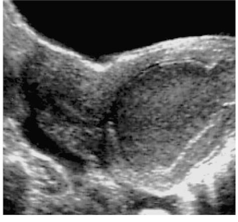 Transabdominal Transverse Ultrasound Images Showing A Double Uterus