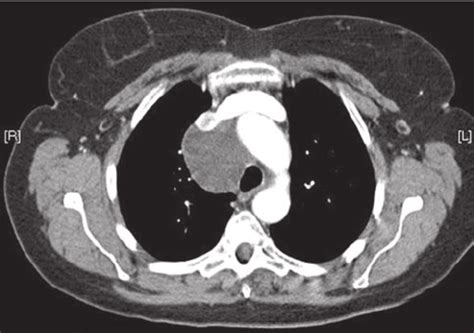 Chest Ct Scanning Image Of A Bronchogenic Cyst Extending To The
