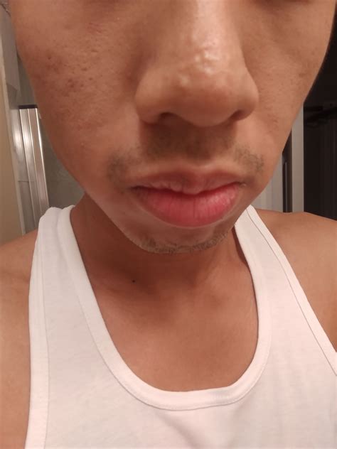 Skin Concerns How Do I Get Rid Of These Bumps On My Nose Skin