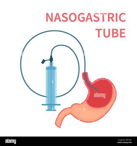 Nasogastric Feeding Tube Illustration Stock Photo Alamy