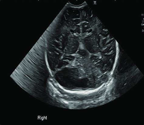 Cranial Ultrasound Image With Fluid Echogenicity Structure Occupying