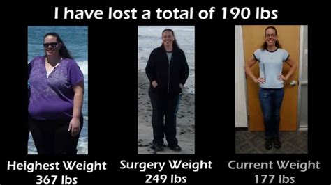 1 Year After Gastric Bypass Surgery A Patients Journey Youtube
