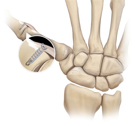 Arthrex 2 5 Mm PushLock Thumb Collateral Ligament Repair