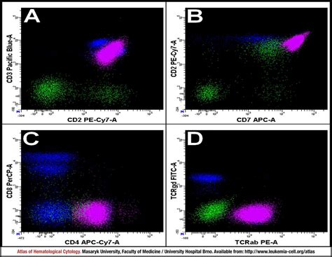 T Cell Prolymphocytic Leukaemia Cell Atlas Of Haematological Cytology