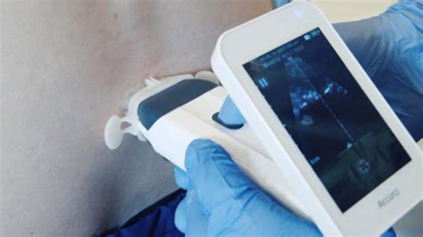 New Device Helps Locate Perfect Spot For Epidural Cbs Boston
