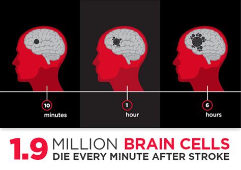 19 Million Brain Cells Die Every Minute After Stroke Emergency