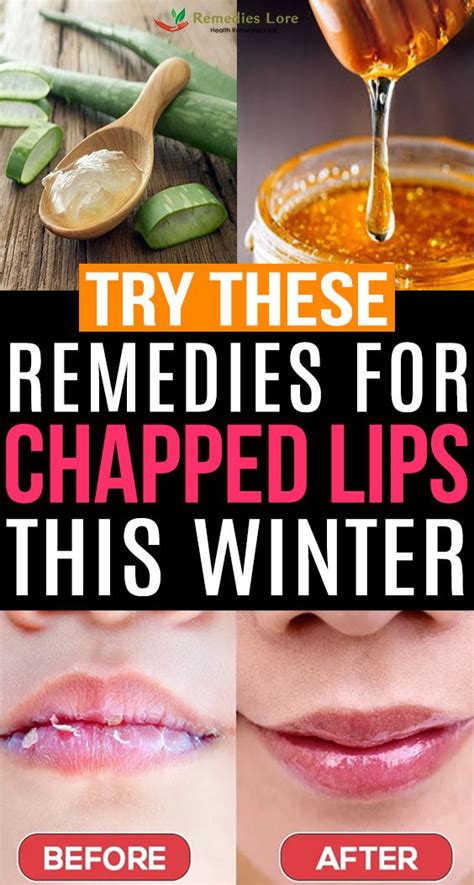 Try These Remedies For Chapped Lips This Winter Chapped Lips Chapped