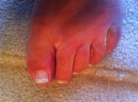 These infections are quite common and often cause an irritating rash. Stubborn Fungal Infection in Toe - Purely Earth