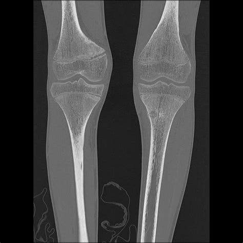 Osgoodschlatter Disease And Tibial Stress Fracture Image