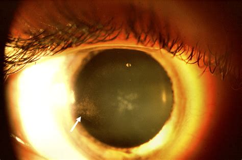 Figure 1 From Superficial Keratectomy After Epi Lasik Semantic Scholar