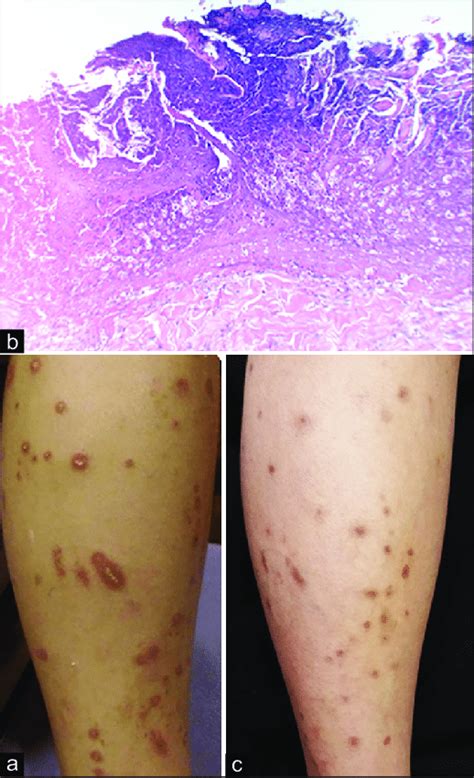 Images Of The Patient A Hyperkeratotic Erythematous Papules With