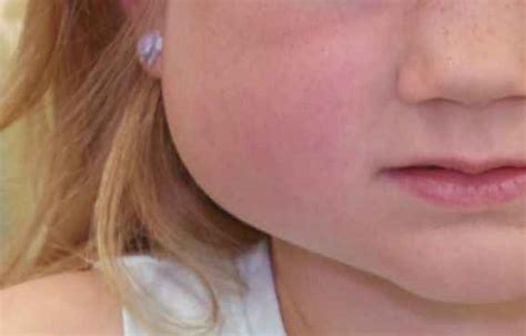 Swollen Cheek Symptoms Causes Treatment Pictures 2022