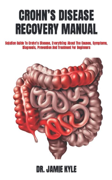 Buy Crohns Disease Recovery Manual Solution Guide To Crohns Disease Everything About The
