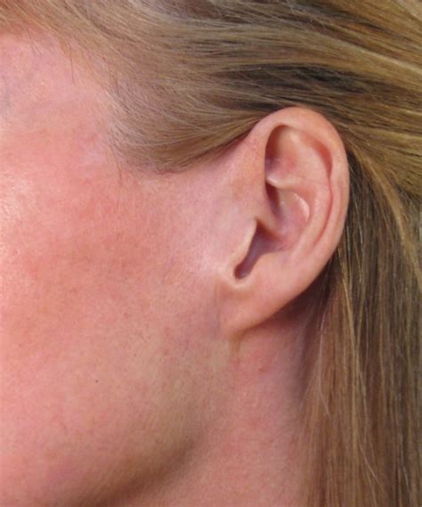 San Diego Well Healed Facelift Incision