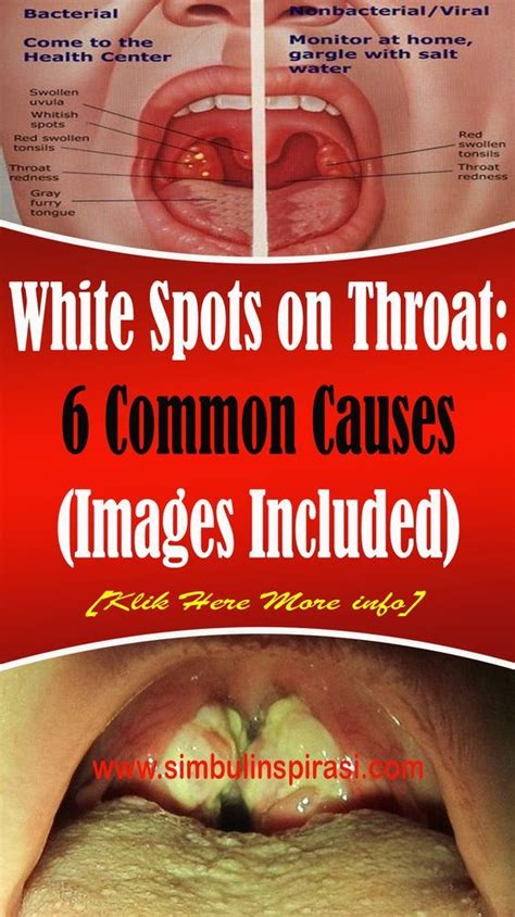 Throat White Spots On Tonsils